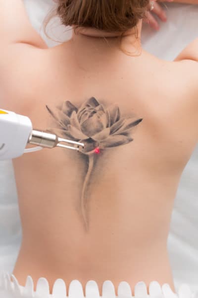 הסרת קעקועים